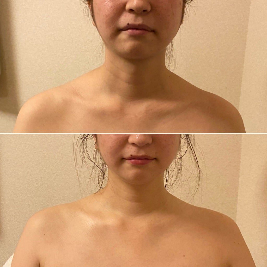 首から肩、デコルテの施術前と施術後の比較写真。上が施術前、下が施術後